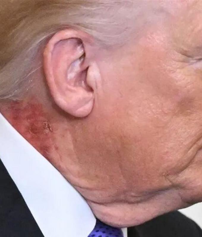 بعد ظهور بقع حمراء على رقبته.. هذا ما قاله طبيب ترامب