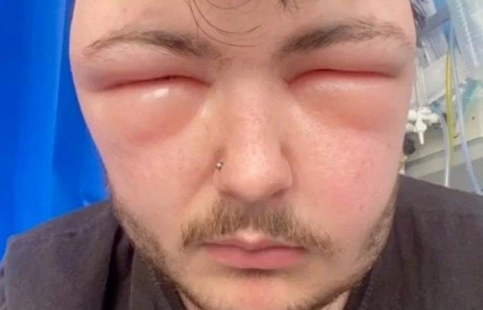 صبغة شعر تشوه وجه شاب