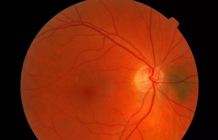 علماء يبتكرون إبرة مجهرية للعين 'ذاتية التوصيل'
