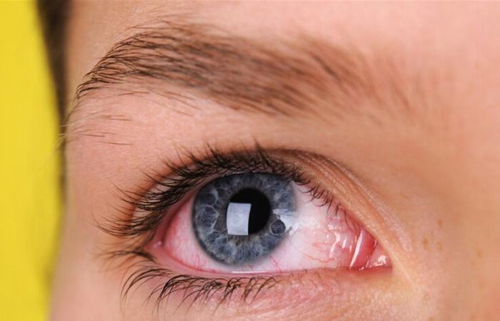 هذا ما يكشفه احمرار العين عن صحتك