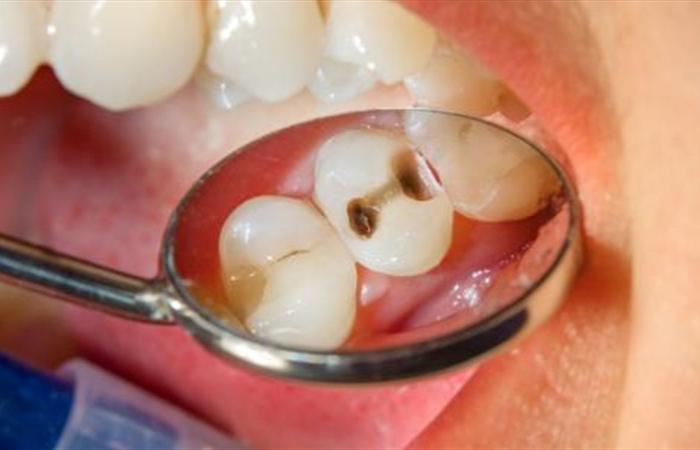 طبيب أسنان يبدد الأسطورة الشائعة حول فوائد الصودا الحلوة