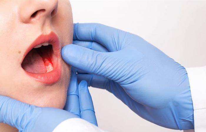 سرطان تجويف الفم.. ما هي أعراضه؟