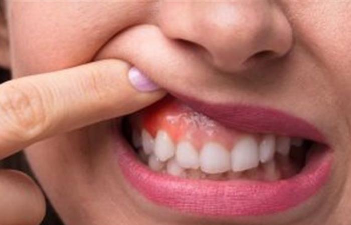 أعراض مؤلمة في فمك تشير إلى الإصابة بالأنفلونزا