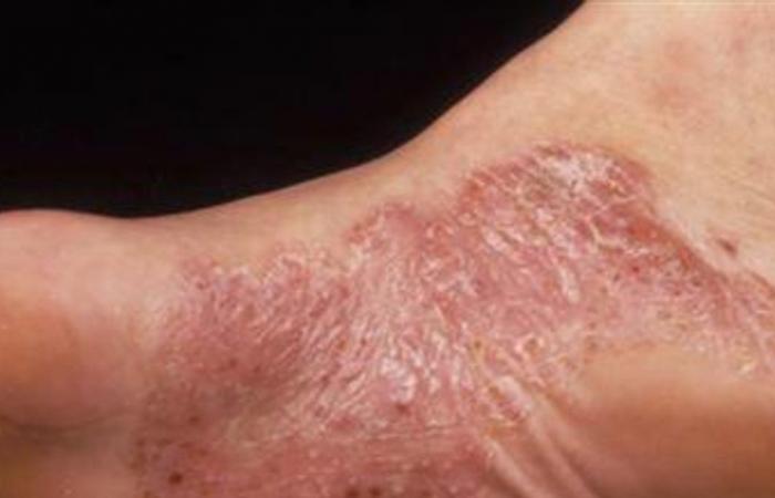 الأمراض الجلدية الأكثر شيوعاً...الأسباب والعلاج