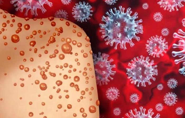 لا يُعرف عنه الكثير ويُثير مخاوف عالمية.. نيويورك تؤكد أول إصابة بجدري القردة