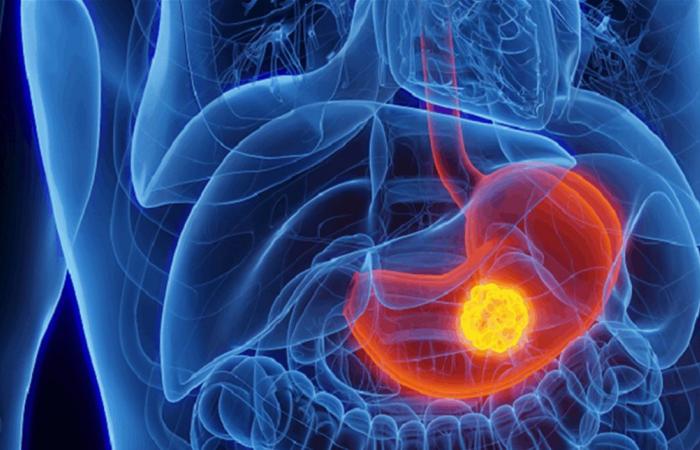 منتج يزيد من خطر الإصابة بسرطان المعدة!