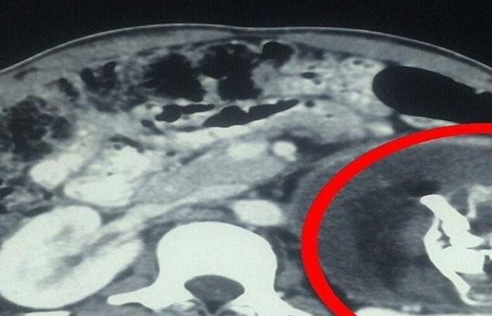 أفغانستان.. استخراج جنين من بطن رضيع