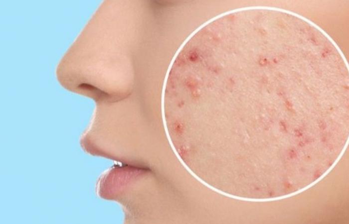 نتائجها مفاجئة.. دراسة تكشف علاقة "حب الشباب" باضطرابات الأكل!