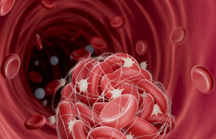 تقنية ترصد تجلّط الدم من دون تدخل جراحي... تعرّف إليها