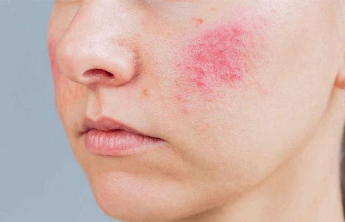 لماذا يزداد احمرار الوجه مع التقدم في العمر؟