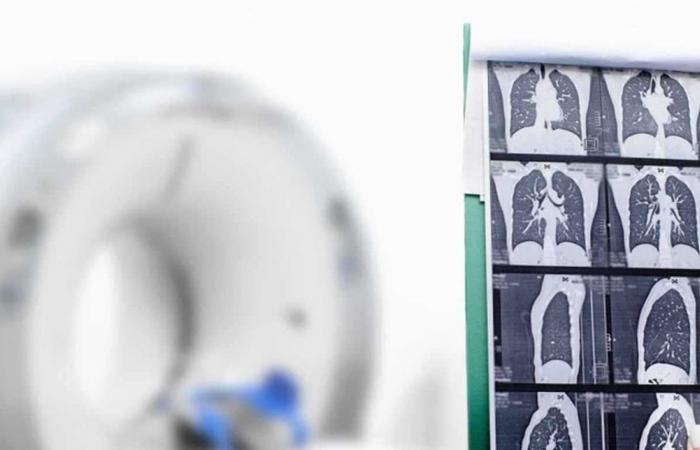 علماء يكشفون آلية جديدة قد تساهم في علاج سرطان الرئة العدواني.. تعرف إليها