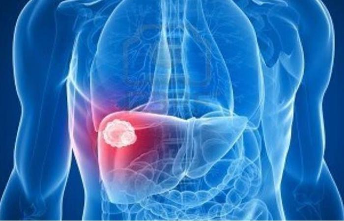 زوج يقاضي زوجته بعد رفضها التبرع له بالكبد!