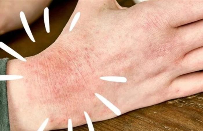 نصائح للتخلص من مشكلة إكزيما الشتاء.. هذا ما يجب فعله