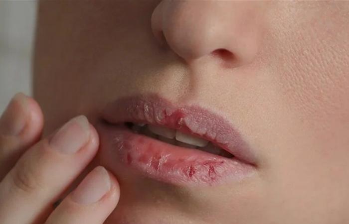 تشققات الشفاه المستمرة.. اكثر من مجرد جفاف