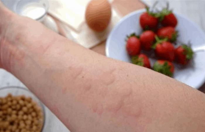 توقف عالمي للدواء الوحيد لحساسية الفول السوداني