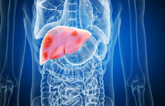 هل الصيام آمن لمرضى الكبد؟