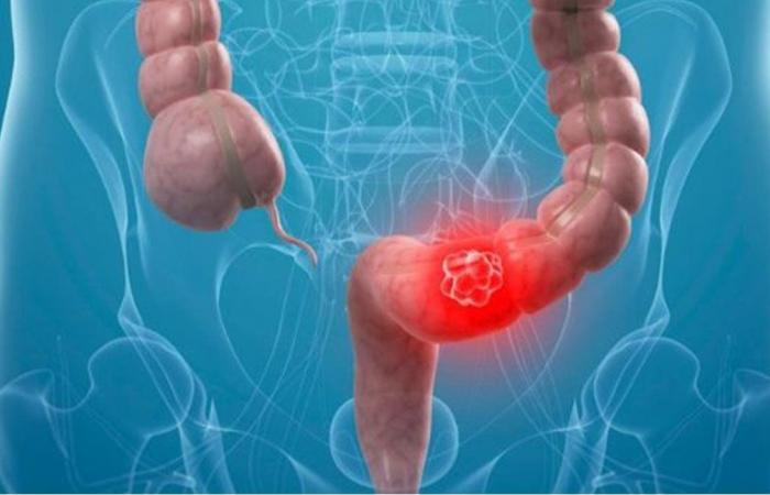 احمِ أمعاءك.. 4 أطعمة تقلل خطر الإصابة بسرطان القولون!