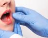 سرطان تجويف الفم.. ما هي أعراضه؟